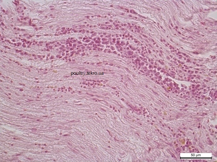 Infiltraciya polimorfnymy limfoblastnymy klitynamy u nervovu tkanynu poperekovo-kryzhovogo spletennya