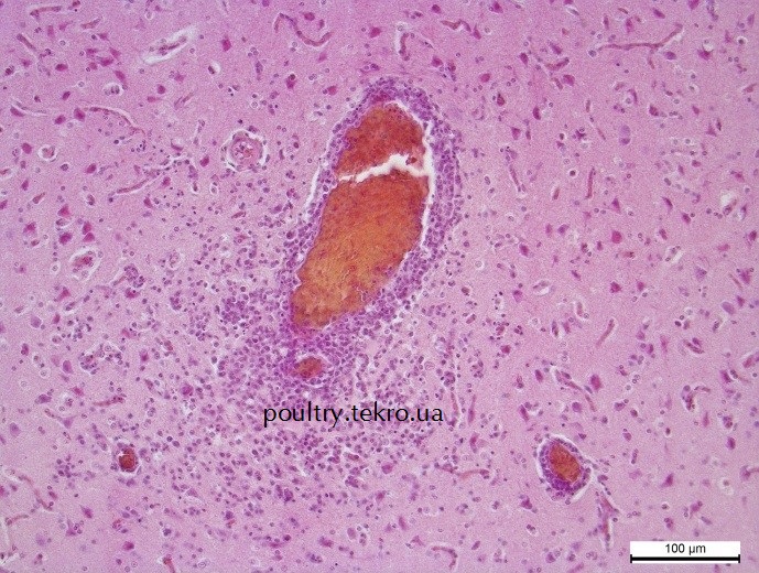 Peryvazalna infiltraciya pleomorfnymy limfoblastnymy